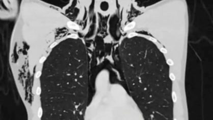 Jovem é internado na UTI após desenvolver condição pulmonar rara ao se masturbar